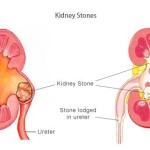 Kidney Stone