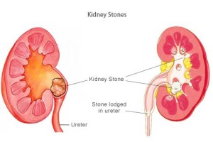 Kidney Stone