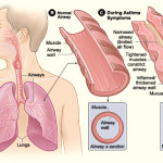 Asthma Symptoms Treatment