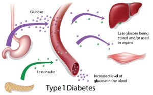 Type 1 diabetes