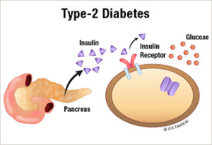 Type 2 diabetes