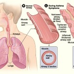 asthma allergy