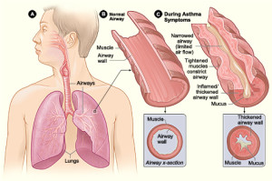  Asthma Symptoms Treatment